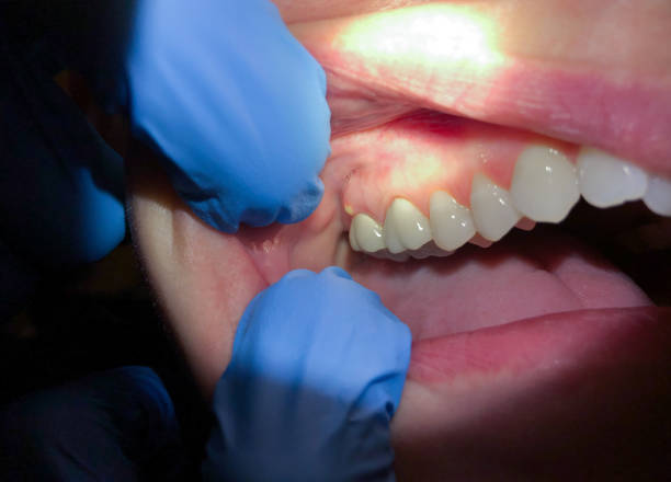 Best Emergency Wisdom Tooth Extraction in Harker Heights, TX